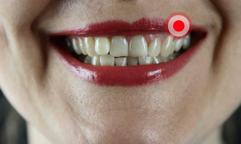koortslip lip